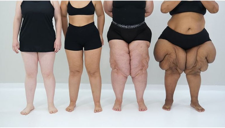 Desvendando o lipedema: Como a nutrição pode fazer a diferença